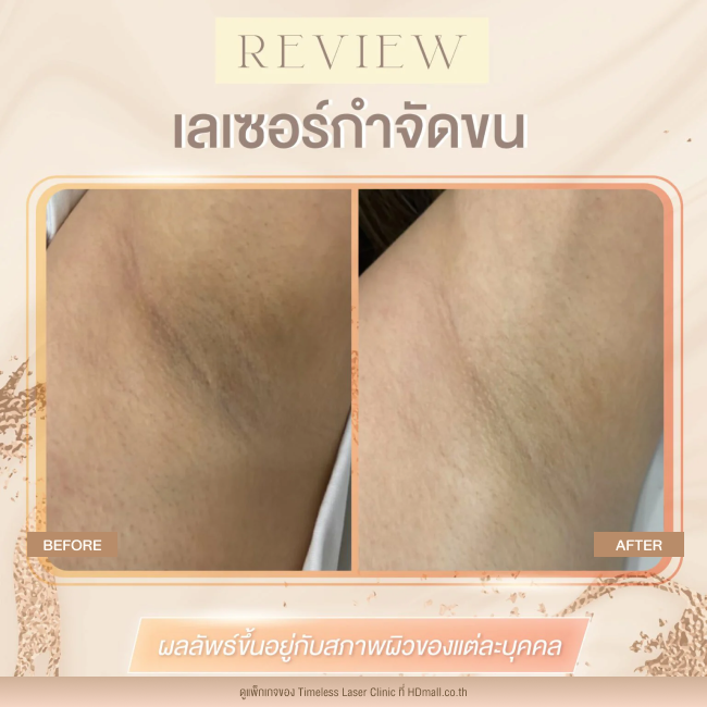 ผลลัพธ์หลังใช้บริการเลเซอร์กำจัดขน โปรแกรม Diode Laser ที่ Timeless Laser Clinic รูป 6