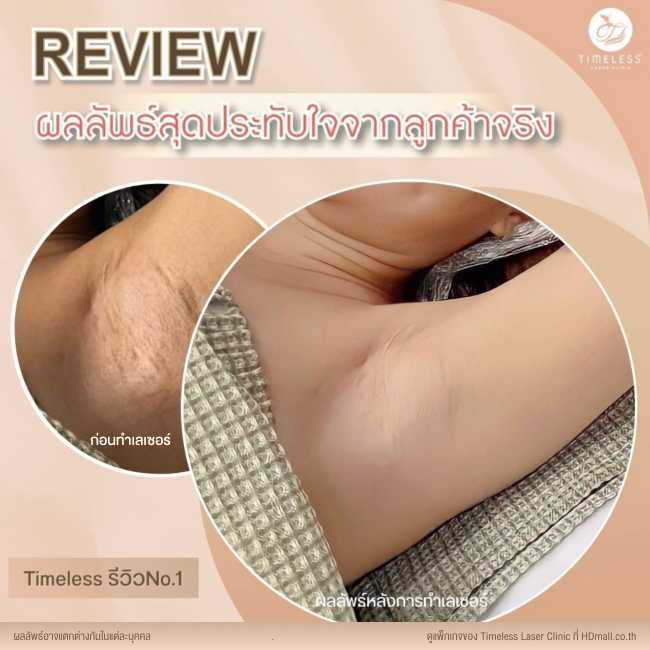 ผลลัพธ์หลังใช้บริการเลเซอร์กำจัดขน โปรแกรม Diode Laser ที่ Timeless Laser Clinic รูป 5