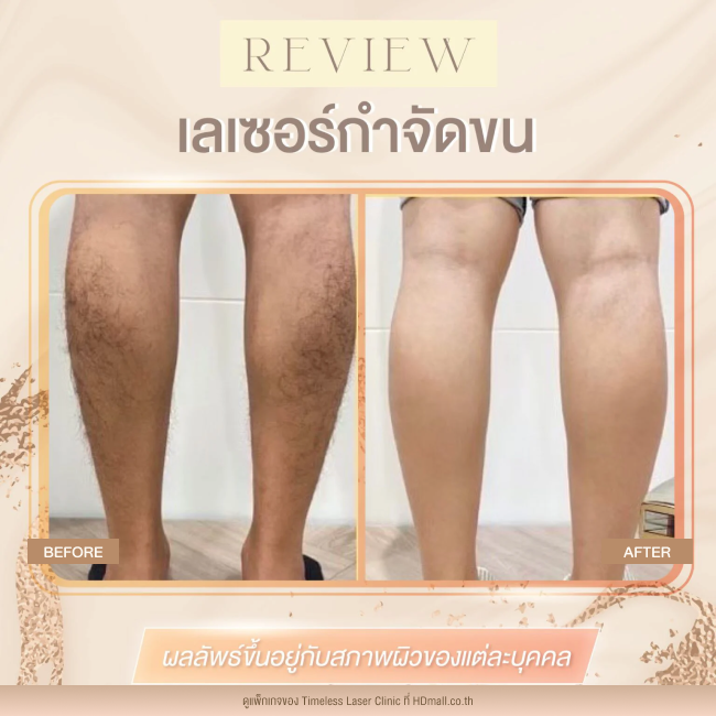 ผลลัพธ์หลังใช้บริการเลเซอร์กำจัดขน โปรแกรม Diode Laser ที่ Timeless Laser Clinic รูป 7