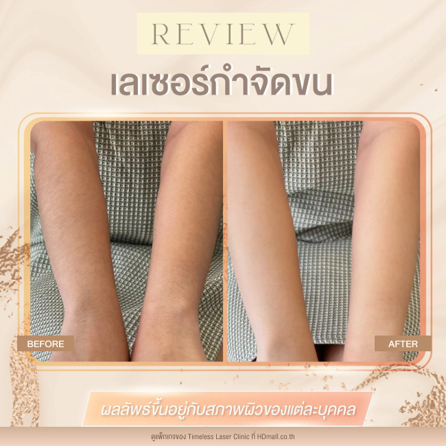 ผลลัพธ์หลังใช้บริการเลเซอร์กำจัดขน โปรแกรม Diode Laser ที่ Timeless Laser Clinic รูป 8