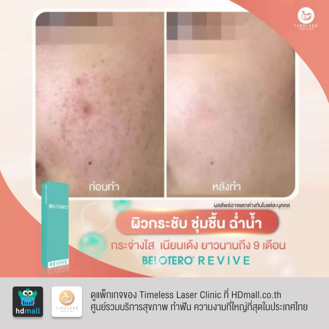 รีวิวฉีดฟิลเลอร์หน้าใส โปรแกรมฉีดฟิลเลอร์ Belotero Revive ที่ Timeless Laser Clinic รูป 8