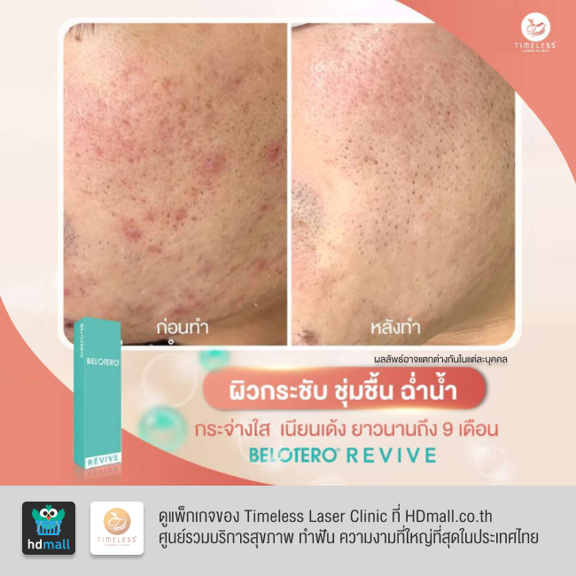 รีวิวฉีดฟิลเลอร์หน้าใส โปรแกรมฉีดฟิลเลอร์ Belotero Revive ที่ Timeless Laser Clinic รูป 10