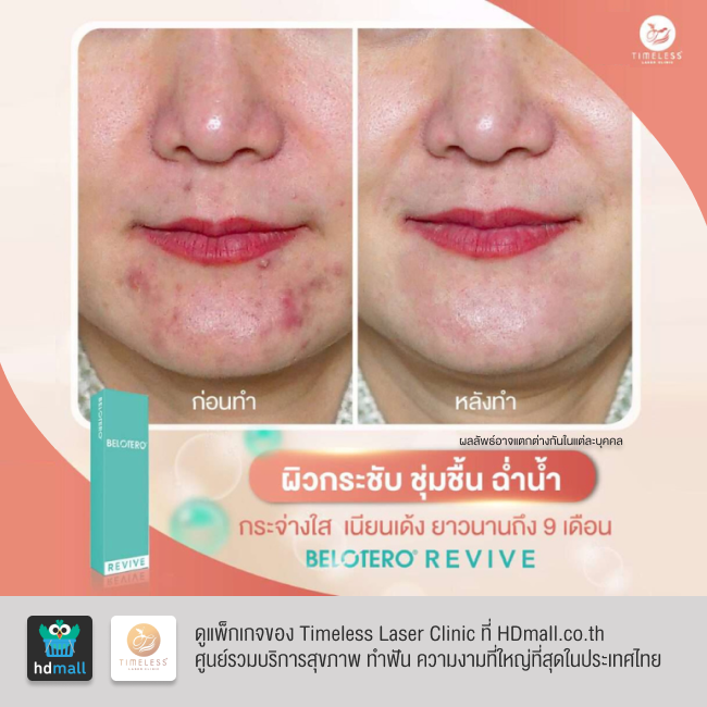 รีวิวฉีดฟิลเลอร์หน้าใส โปรแกรมฉีดฟิลเลอร์ Belotero Revive ที่ Timeless Laser Clinic รูป 11