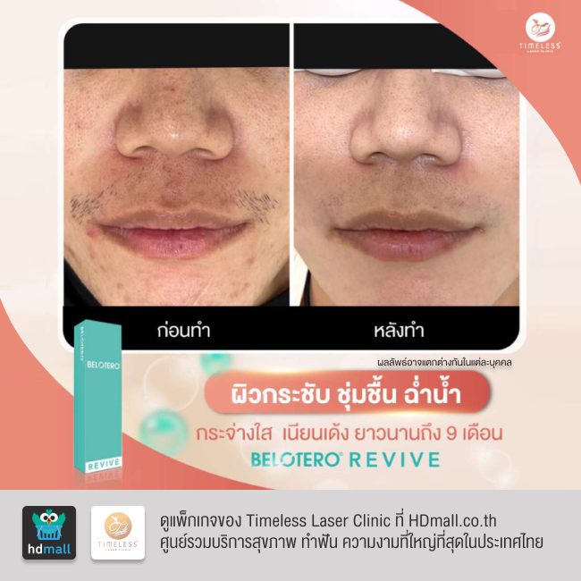 รีวิวฉีดฟิลเลอร์หน้าใส โปรแกรมฉีดฟิลเลอร์ Belotero Revive ที่ Timeless Laser Clinic รูป 1