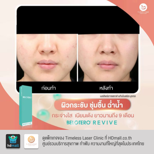 รีวิวฉีดฟิลเลอร์หน้าใส โปรแกรมฉีดฟิลเลอร์ Belotero Revive ที่ Timeless Laser Clinic รูป 2