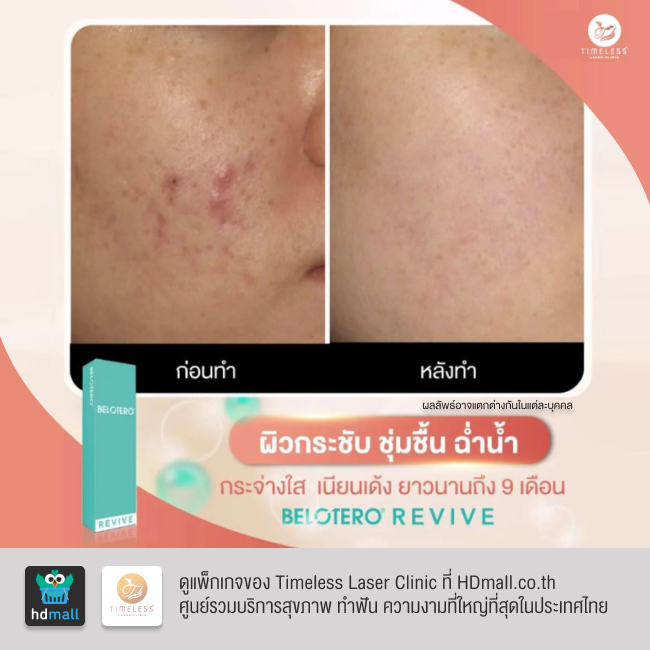 รีวิวฉีดฟิลเลอร์หน้าใส โปรแกรมฉีดฟิลเลอร์ Belotero Revive ที่ Timeless Laser Clinic รูป 3