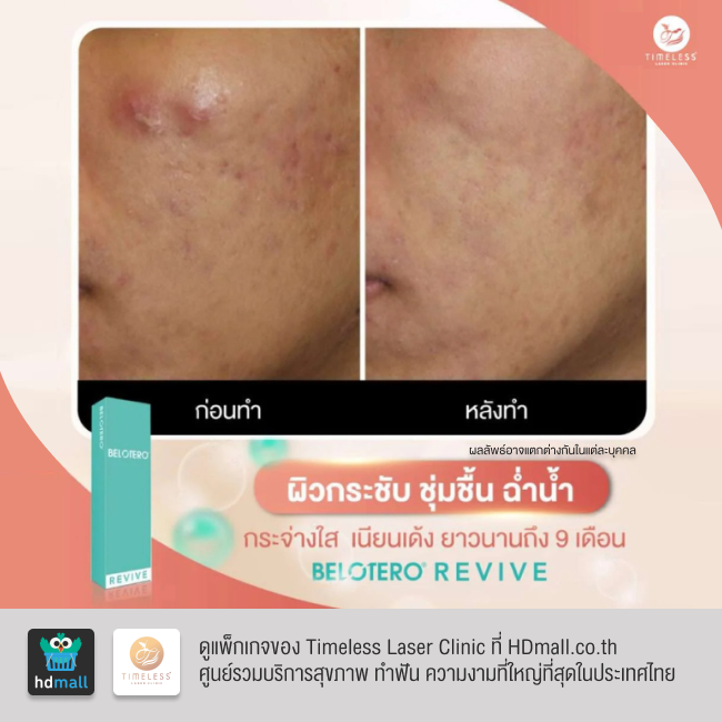 รีวิวฉีดฟิลเลอร์หน้าใส โปรแกรมฉีดฟิลเลอร์ Belotero Revive ที่ Timeless Laser Clinic รูป 4