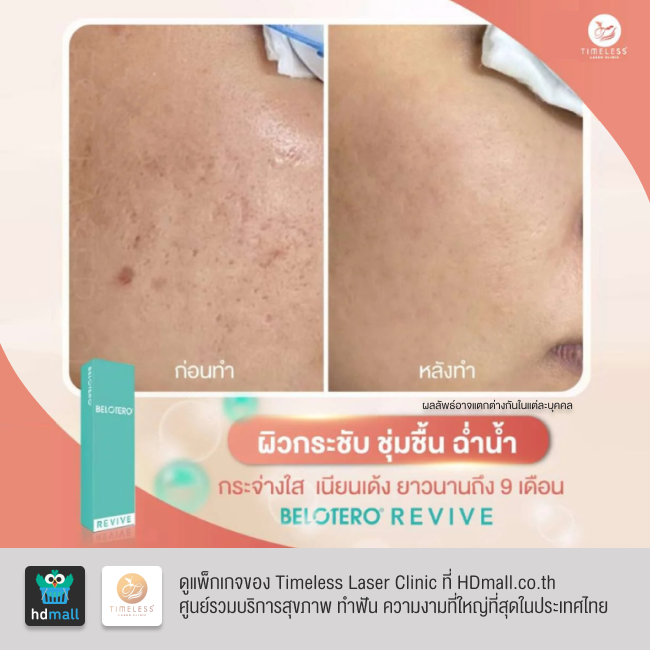 รีวิวฉีดฟิลเลอร์หน้าใส โปรแกรมฉีดฟิลเลอร์ Belotero Revive ที่ Timeless Laser Clinic รูป 6