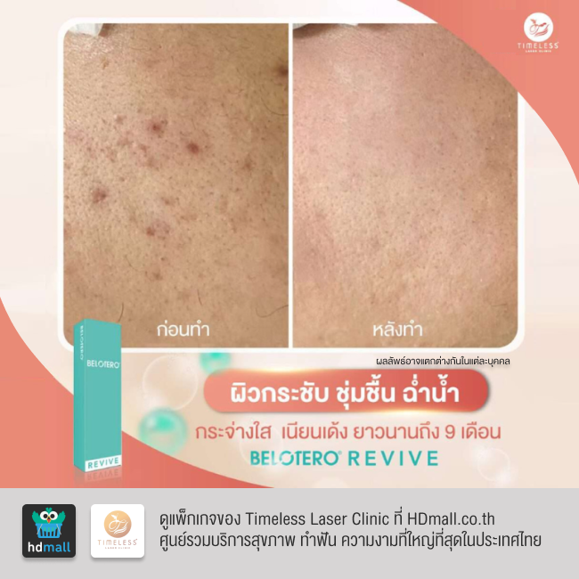 รีวิวฉีดฟิลเลอร์หน้าใส โปรแกรมฉีดฟิลเลอร์ Belotero Revive ที่ Timeless Laser Clinic รูป 7
