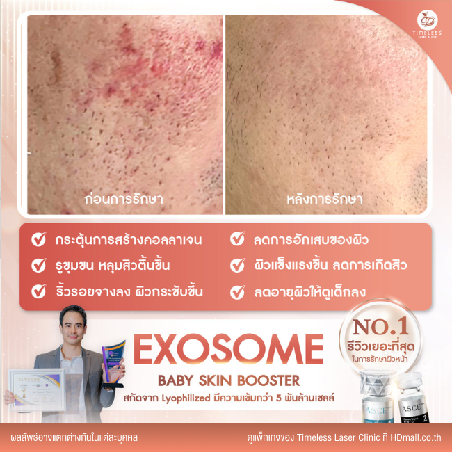 ผลลัพธ์หลังใช้บริการโปรแกรม Exosome ที่ Timeless Laser Clinic รูป 6