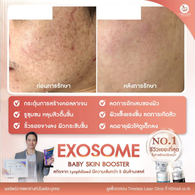 ผลลัพธ์หลังใช้บริการโปรแกรม Exosome ที่ Timeless Laser Clinic รูป 1