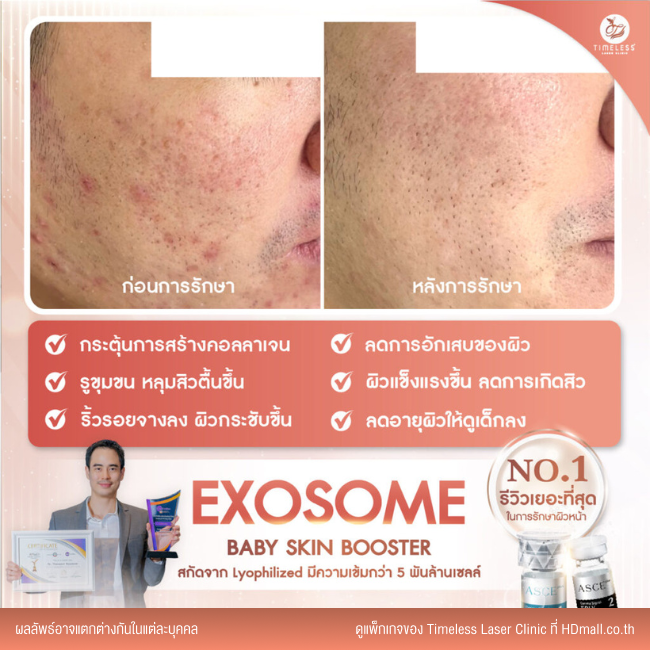 ผลลัพธ์หลังใช้บริการโปรแกรม Exosome ที่ Timeless Laser Clinic รูป 2