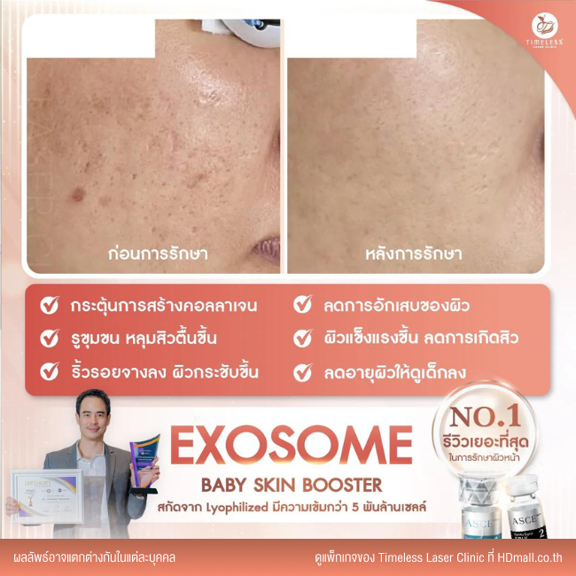 ผลลัพธ์หลังใช้บริการโปรแกรม Exosome ที่ Timeless Laser Clinic รูป 2