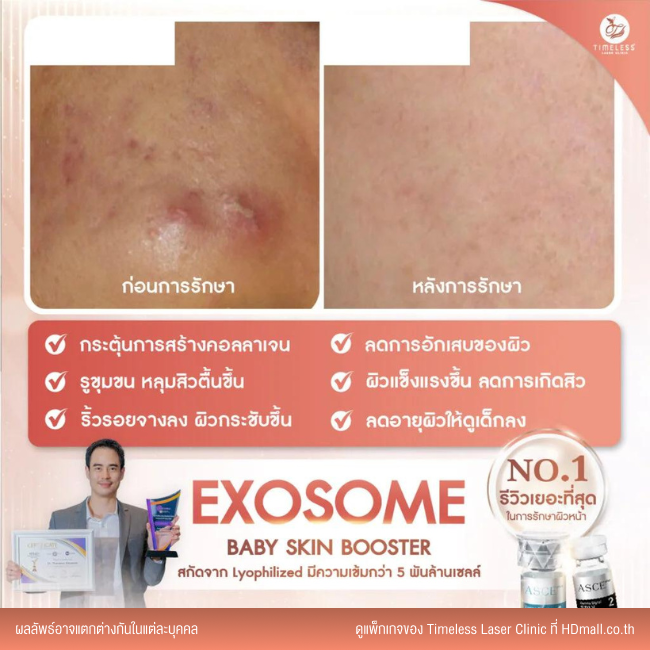 ผลลัพธ์หลังใช้บริการโปรแกรม Exosome ที่ Timeless Laser Clinic รูป 3