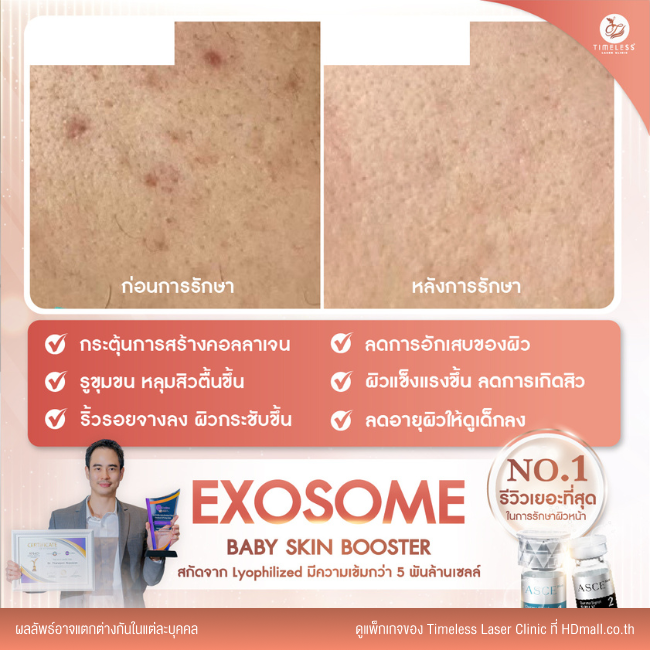 ผลลัพธ์หลังใช้บริการโปรแกรม Exosome ที่ Timeless Laser Clinic รูป 4