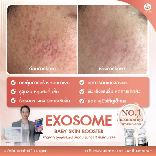 ผลลัพธ์หลังใช้บริการโปรแกรม Exosome ที่ Timeless Laser Clinic รูป 5