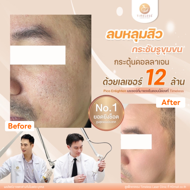ผลลัพธ์หลังเลเซอร์หลุมสิว โปรแกรม Pico Enlighten ที่ Timeless Laser Clinic รูป 9