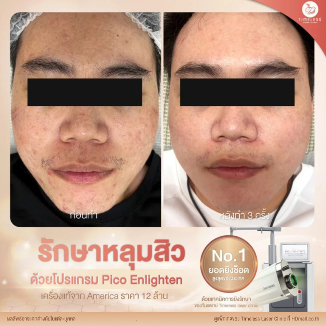ผลลัพธ์หลังเลเซอร์หลุมสิว โปรแกรม Pico Enlighten ที่ Timeless Laser Clinic รูป 11