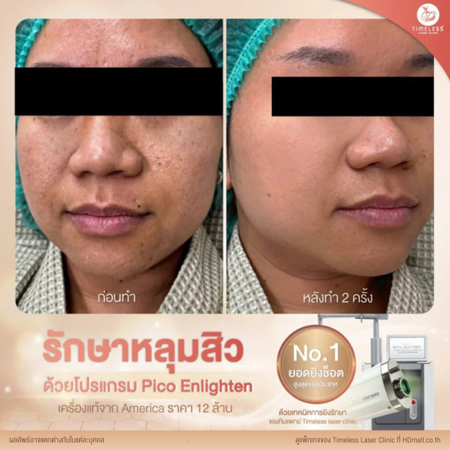 ผลลัพธ์หลังเลเซอร์หลุมสิว โปรแกรม Pico Enlighten ที่ Timeless Laser Clinic รูป 12