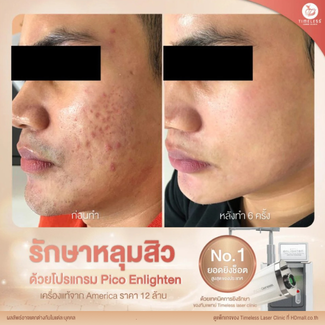 ผลลัพธ์หลังเลเซอร์หลุมสิว โปรแกรม Pico Enlighten ที่ Timeless Laser Clinic รูป 13