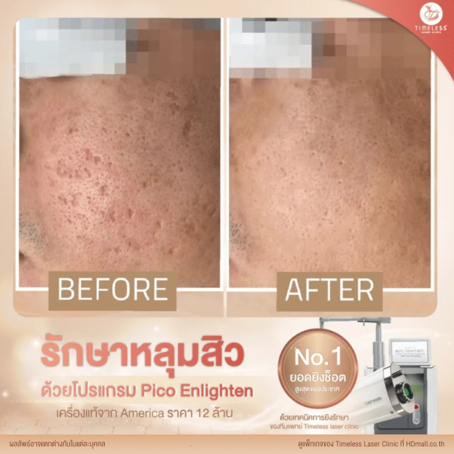 ผลลัพธ์หลังเลเซอร์หลุมสิว โปรแกรม Pico Enlighten ที่ Timeless Laser Clinic รูป 14