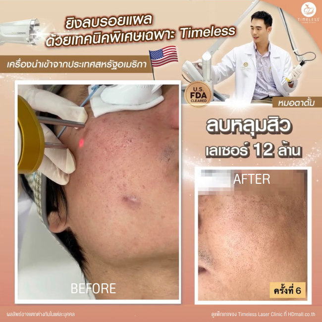 ผลลัพธ์หลังเลเซอร์หลุมสิว โปรแกรม Pico Enlighten ที่ Timeless Laser Clinic รูป 1