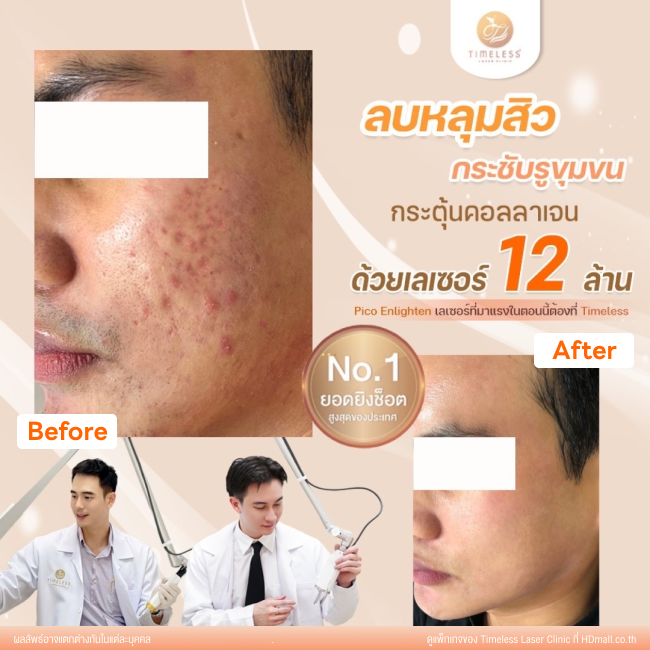 ผลลัพธ์หลังเลเซอร์หลุมสิว โปรแกรม Pico Enlighten ที่ Timeless Laser Clinic รูป 2