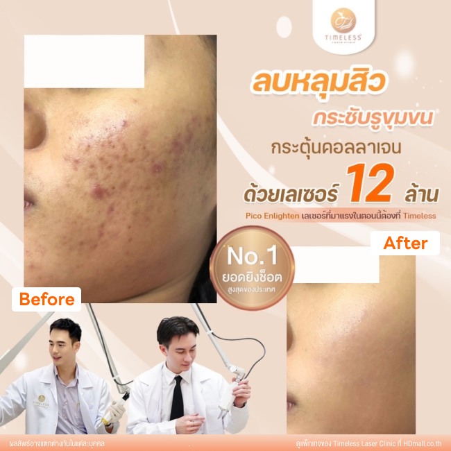 ผลลัพธ์หลังเลเซอร์หลุมสิว โปรแกรม Pico Enlighten ที่ Timeless Laser Clinic รูป 3