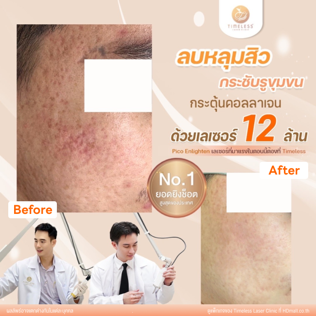 ผลลัพธ์หลังเลเซอร์หลุมสิว โปรแกรม Pico Enlighten ที่ Timeless Laser Clinic รูป 4