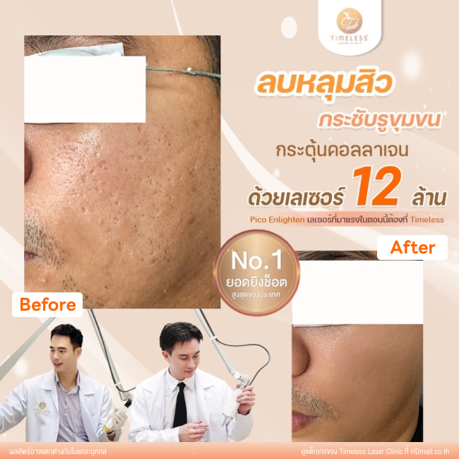 ผลลัพธ์หลังเลเซอร์หลุมสิว โปรแกรม Pico Enlighten ที่ Timeless Laser Clinic รูป 5