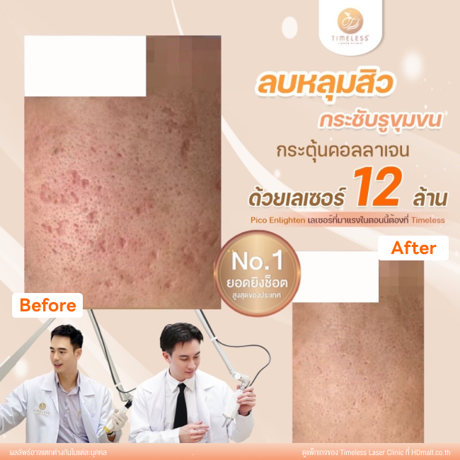 ผลลัพธ์หลังเลเซอร์หลุมสิว โปรแกรม Pico Enlighten ที่ Timeless Laser Clinic รูป 6