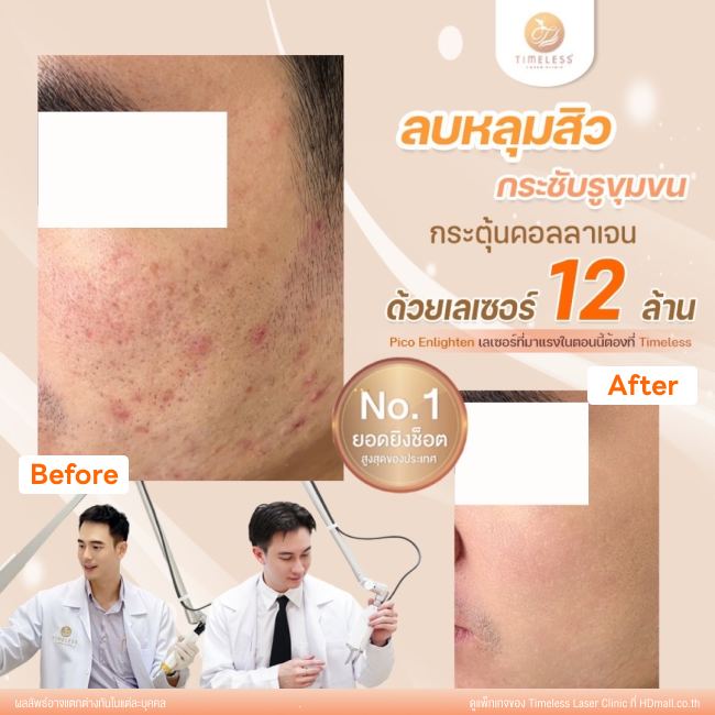 ผลลัพธ์หลังเลเซอร์หลุมสิว โปรแกรม Pico Enlighten ที่ Timeless Laser Clinic รูป 7