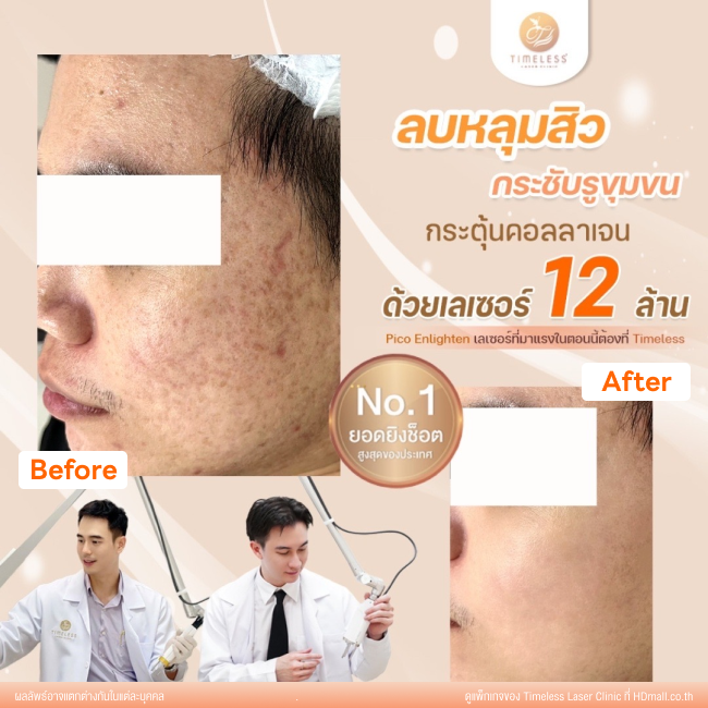 ผลลัพธ์หลังเลเซอร์หลุมสิว โปรแกรม Pico Enlighten ที่ Timeless Laser Clinic รูป 8