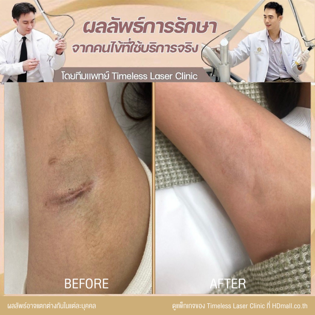 ผลลัพธ์หลังเลเซอร์ลดรอยแผลเป็น โปรแกรม Pico Enlighten ที่ Timeless Laser Clinic รูป 9