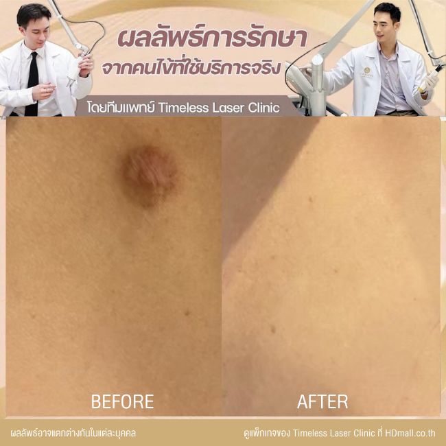 ผลลัพธ์หลังเลเซอร์ลดรอยแผลเป็น โปรแกรม Pico Enlighten ที่ Timeless Laser Clinic รูป 11