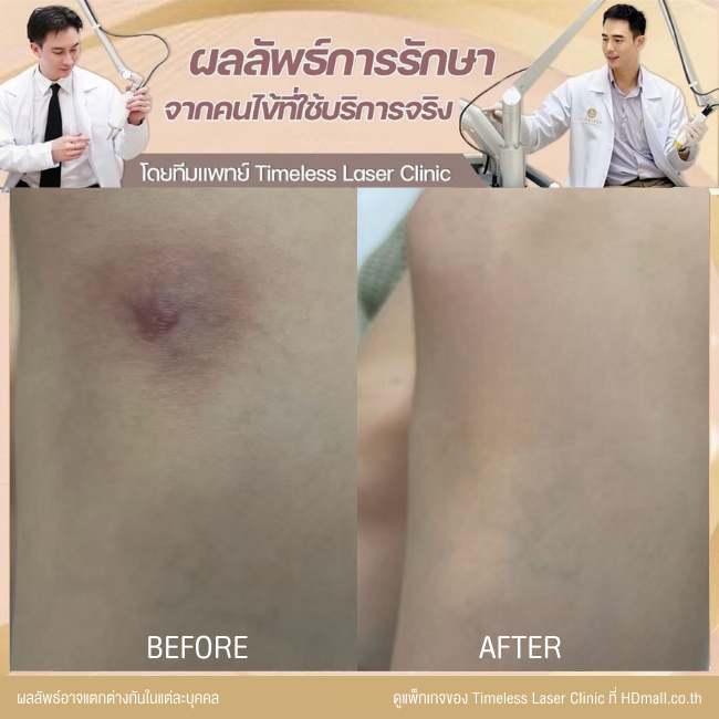 ผลลัพธ์หลังเลเซอร์ลดรอยแผลเป็น โปรแกรม Pico Enlighten ที่ Timeless Laser Clinic รูป 12