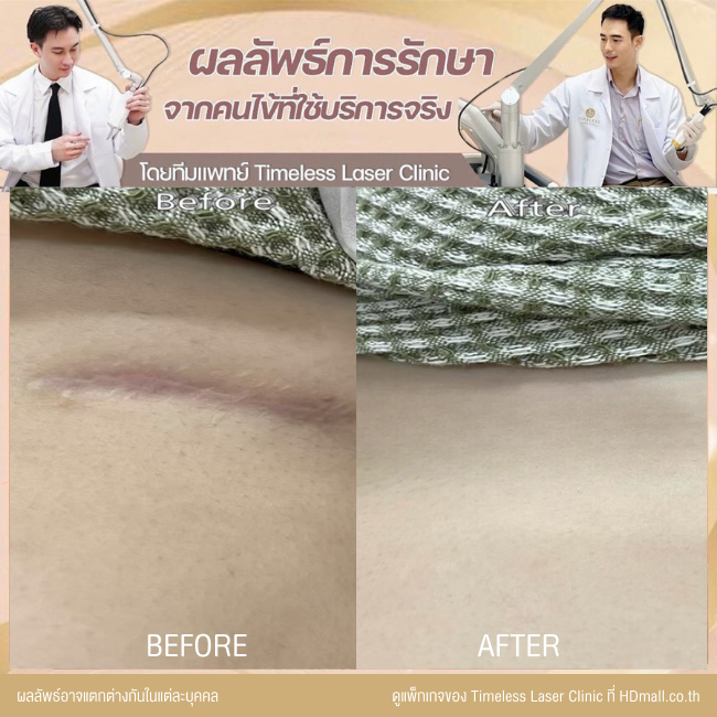 ผลลัพธ์หลังเลเซอร์ลดรอยแผลเป็น โปรแกรม Pico Enlighten ที่ Timeless Laser Clinic รูป 13