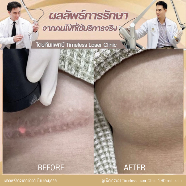 ผลลัพธ์หลังเลเซอร์ลดรอยแผลเป็น โปรแกรม Pico Enlighten ที่ Timeless Laser Clinic รูป 14