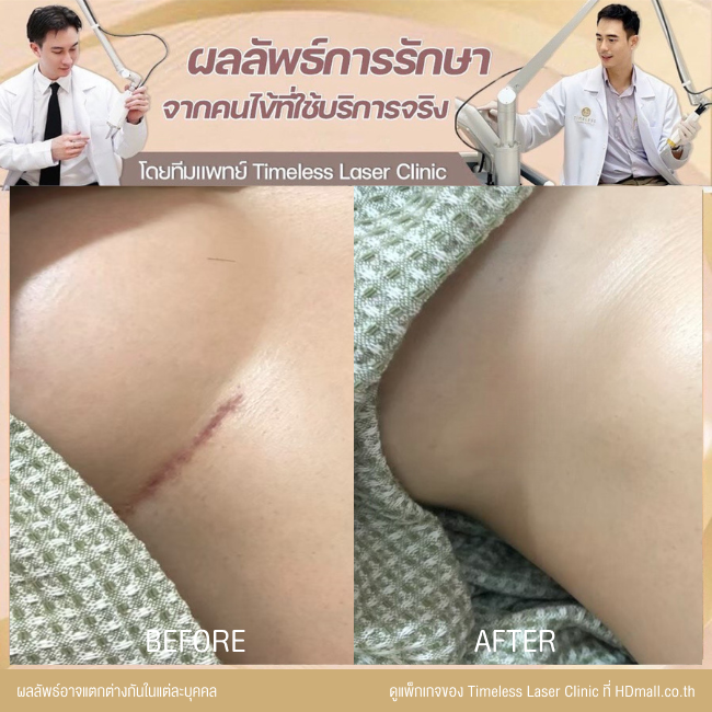 ผลลัพธ์หลังเลเซอร์ลดรอยแผลเป็น โปรแกรม Pico Enlighten ที่ Timeless Laser Clinic รูป 15