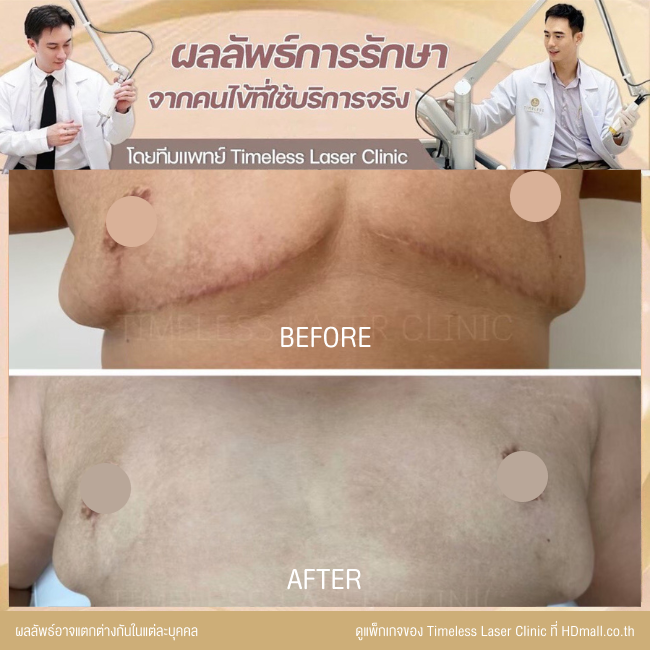 ผลลัพธ์หลังเลเซอร์ลดรอยแผลเป็น โปรแกรม Pico Enlighten ที่ Timeless Laser Clinic รูป 16