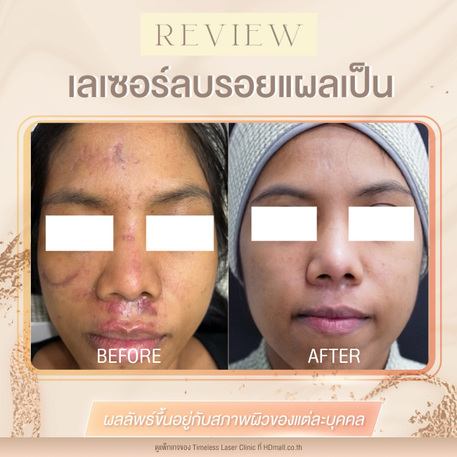 ผลลัพธ์หลังเลเซอร์ลดรอยแผลเป็น โปรแกรม Pico Enlighten ที่ Timeless Laser Clinic รูป 17