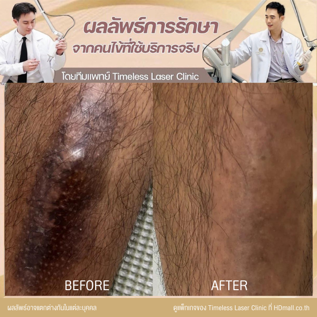 ผลลัพธ์หลังเลเซอร์ลดรอยแผลเป็น โปรแกรม Pico Enlighten ที่ Timeless Laser Clinic รูป 1
