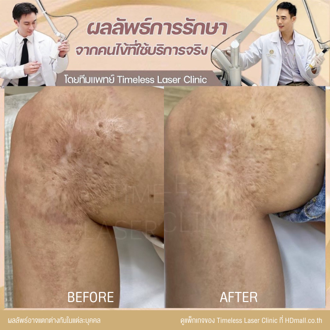 ผลลัพธ์หลังเลเซอร์ลดรอยแผลเป็น โปรแกรม Pico Enlighten ที่ Timeless Laser Clinic รูป 2