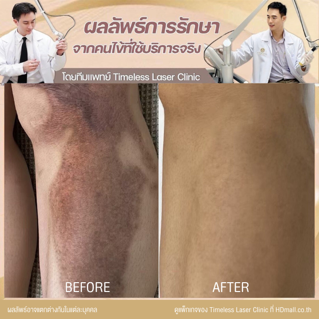 ผลลัพธ์หลังเลเซอร์ลดรอยแผลเป็น โปรแกรม Pico Enlighten ที่ Timeless Laser Clinic รูป 4