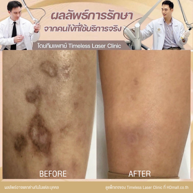 ผลลัพธ์หลังเลเซอร์ลดรอยแผลเป็น โปรแกรม Pico Enlighten ที่ Timeless Laser Clinic รูป 5