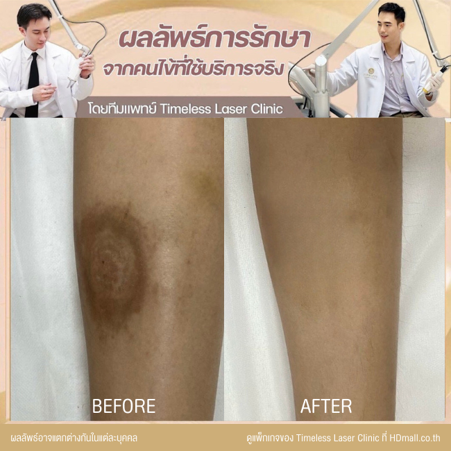 ผลลัพธ์หลังเลเซอร์ลดรอยแผลเป็น โปรแกรม Pico Enlighten ที่ Timeless Laser Clinic รูป 6