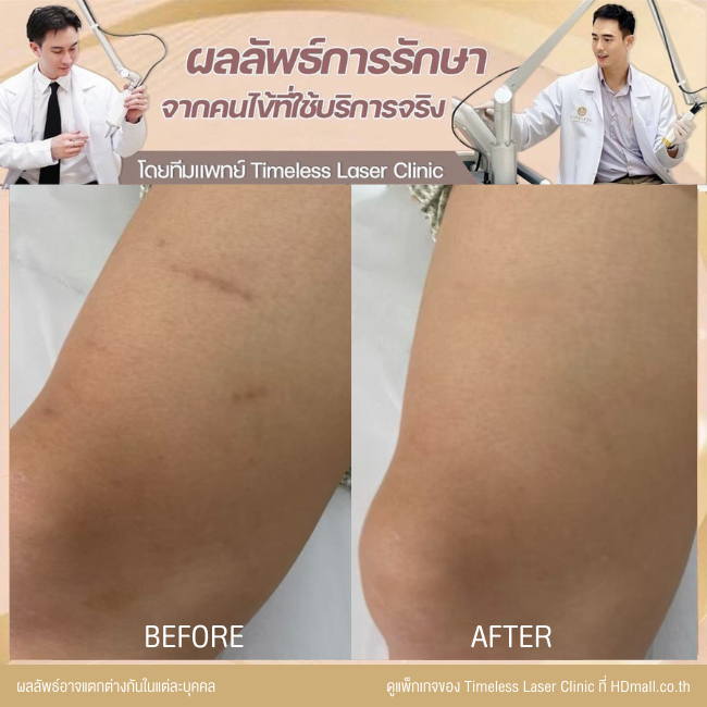 ผลลัพธ์หลังเลเซอร์ลดรอยแผลเป็น โปรแกรม Pico Enlighten ที่ Timeless Laser Clinic รูป 7