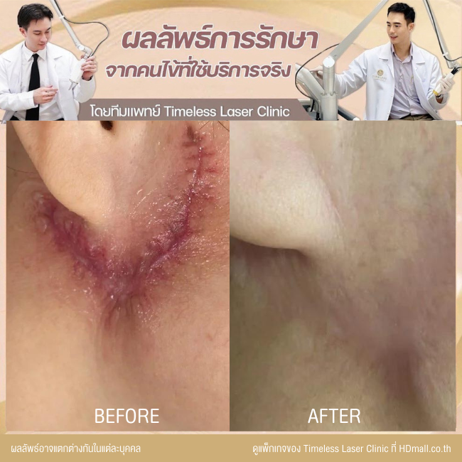 ผลลัพธ์หลังเลเซอร์ลดรอยแผลเป็น โปรแกรม Pico Enlighten ที่ Timeless Laser Clinic รูป 8
