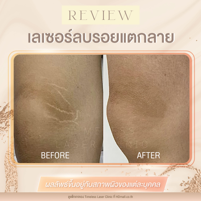 ผลลัพธ์หลังเลเซอร์ลดรอยแตกลาย โปรแกรม Pico Enlighten ที่ Timeless Laser Clinic รูป9