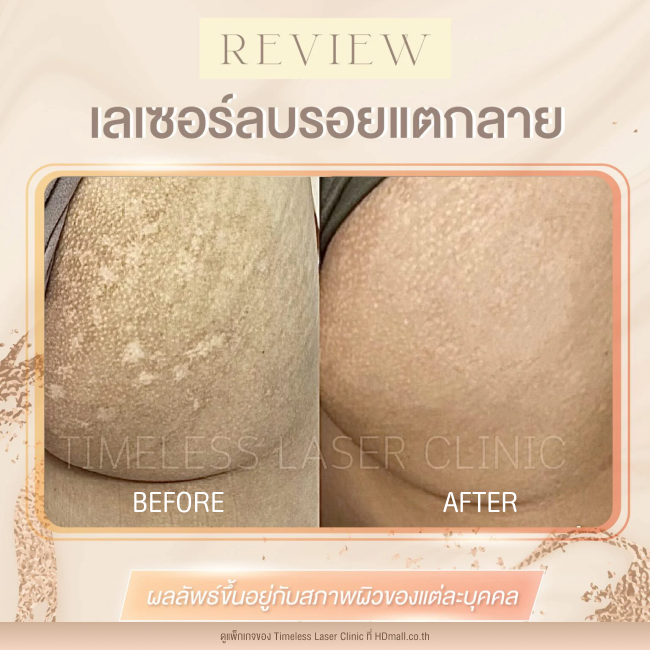 ผลลัพธ์หลังเลเซอร์ลดรอยแตกลาย โปรแกรม Pico Enlighten ที่ Timeless Laser Clinic รูป11